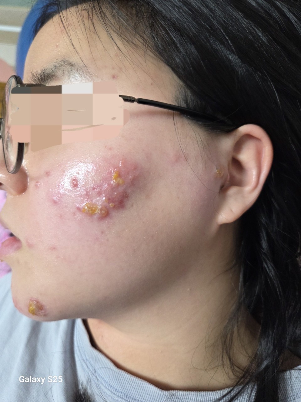 대상포진 5일만에 다 나은 여성