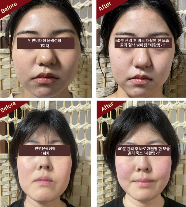 체형교정 Before & After 📸