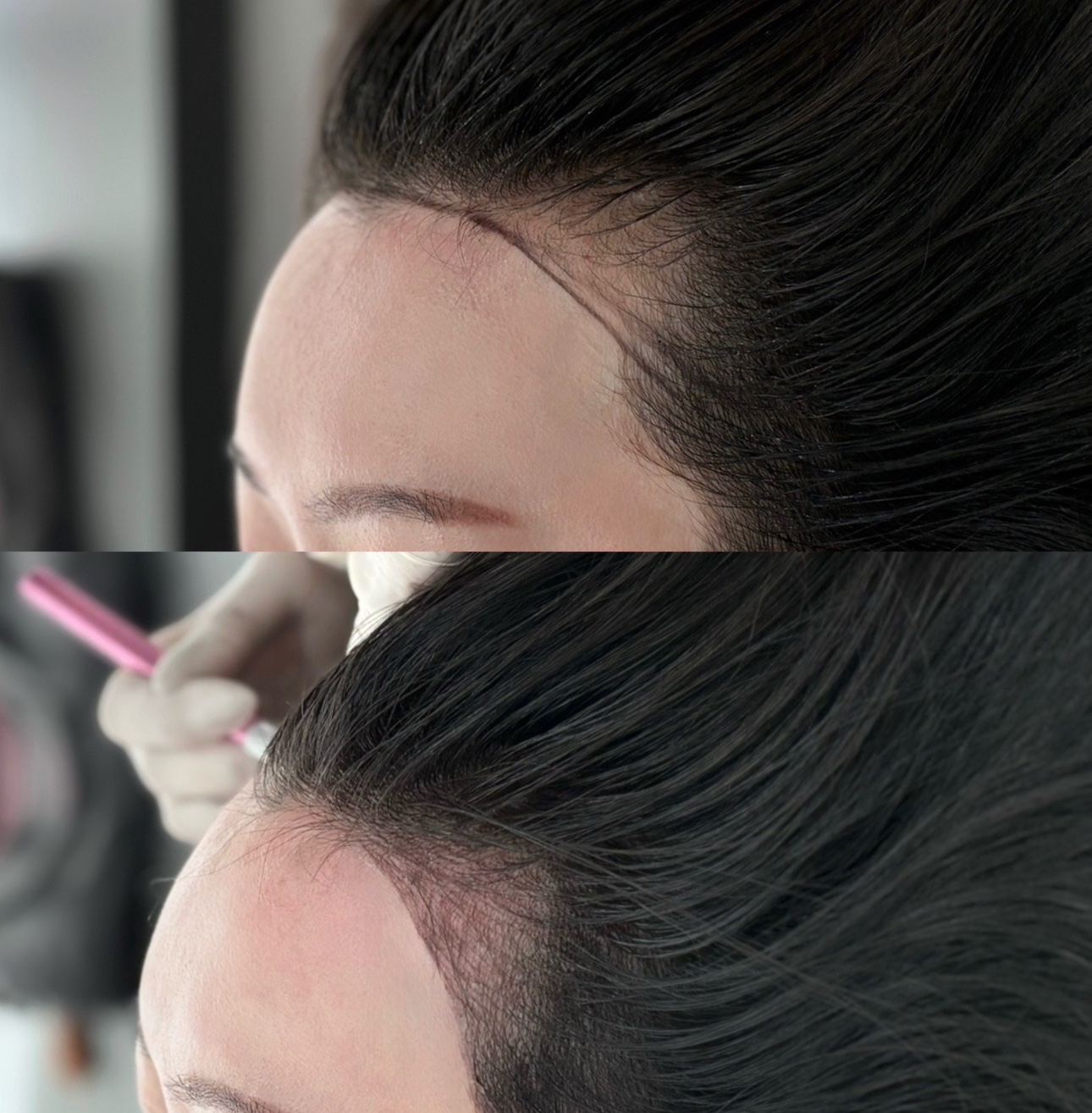 M자탈모 헤어라인반영구로 커버가능‼️