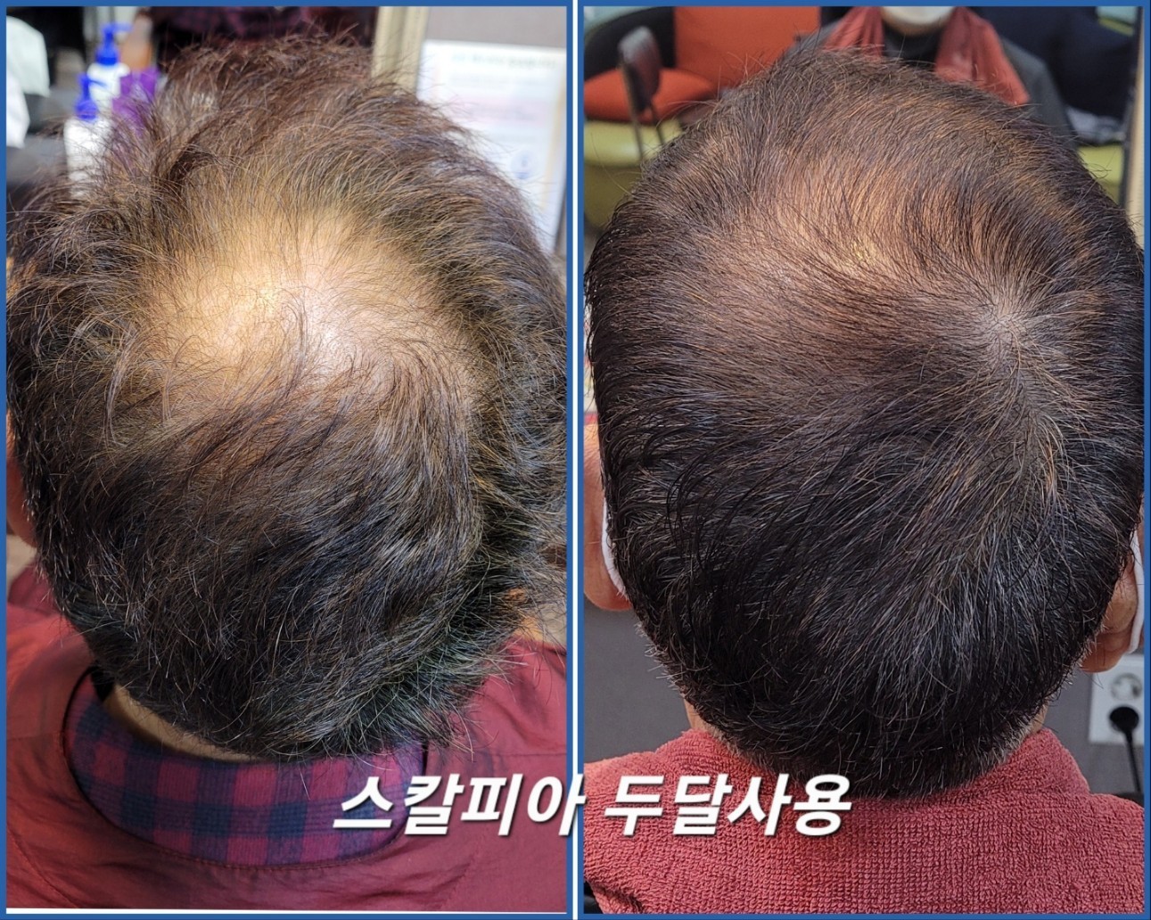 탈모 두피 홈케어
