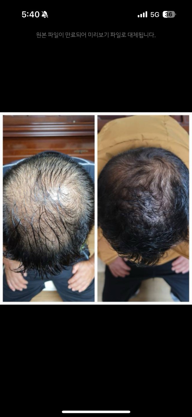 탈모 두피 홈케어