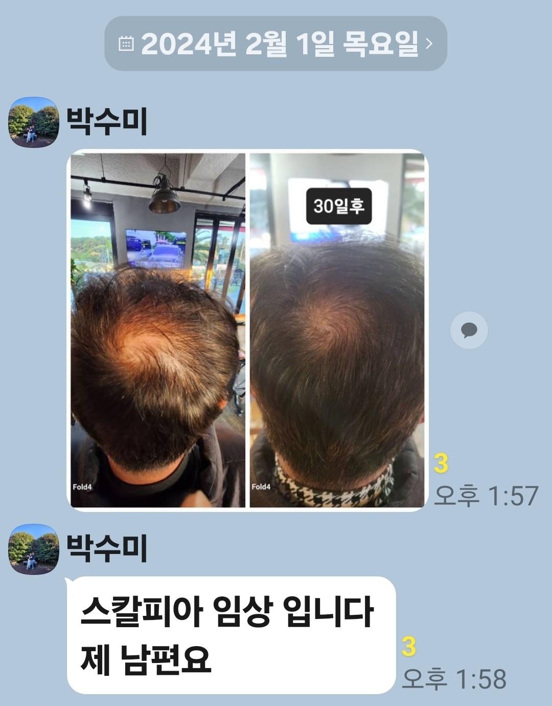 탈모 두피 홈케어