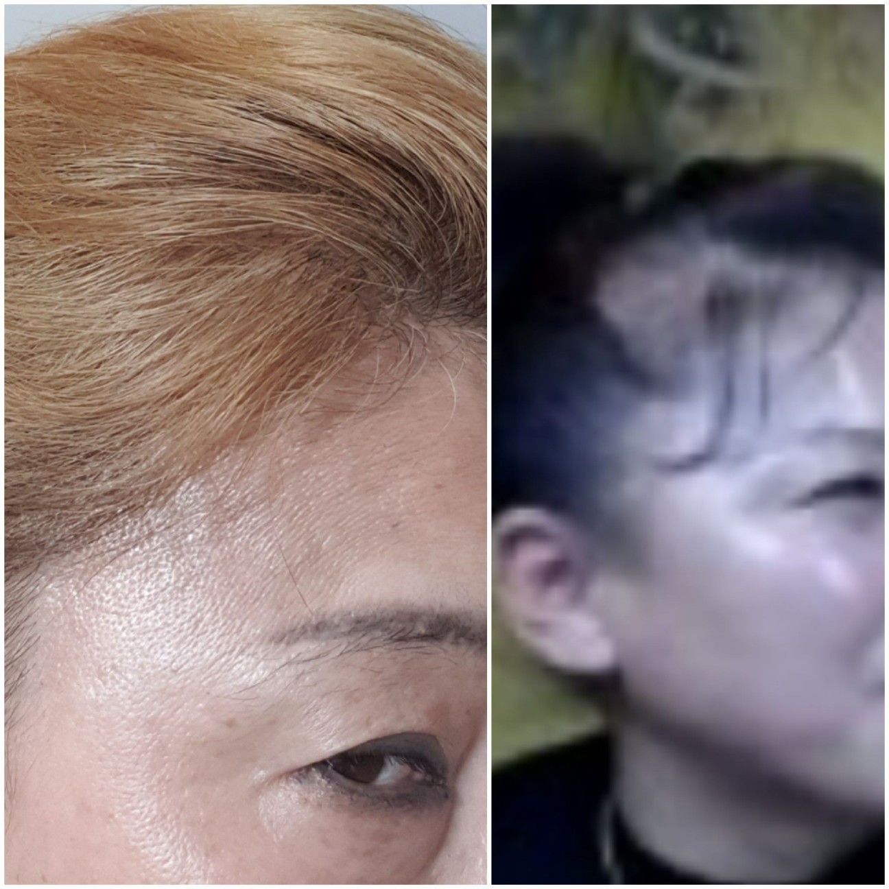 탈모 두피 홈케어