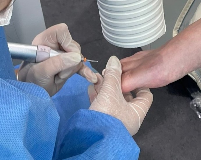 🏩발톱무좀, 병원치료 방법은?+꿀팁