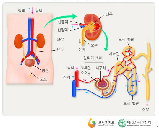 신장질환 원인과 신장기능 저하시 증상