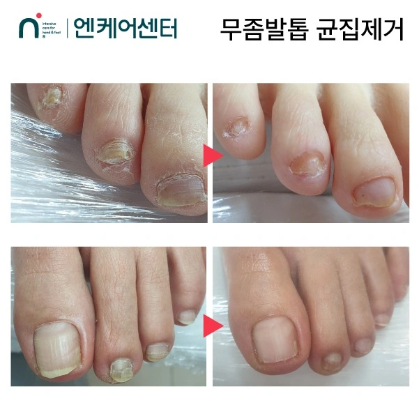 무좀발톱 관리