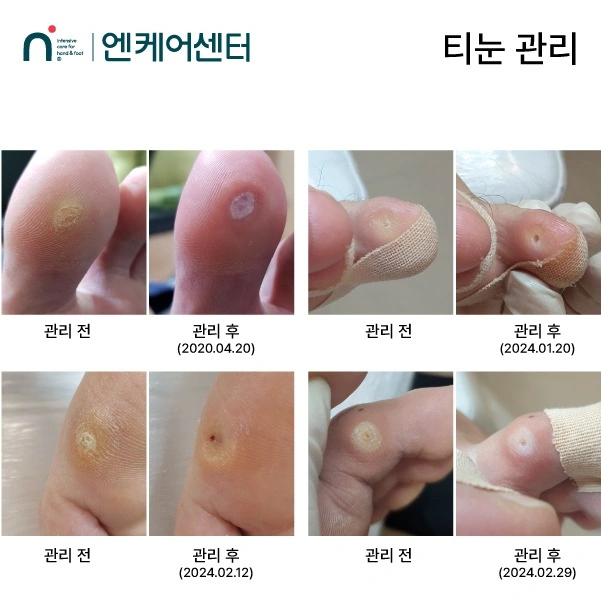 심한발각질,티눈,사마귀 구합니다.(교육모델)