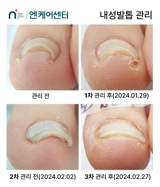 염증내성발톱 실습모델