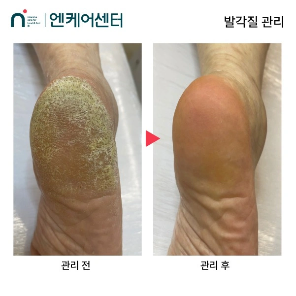 발각질 수업 모델