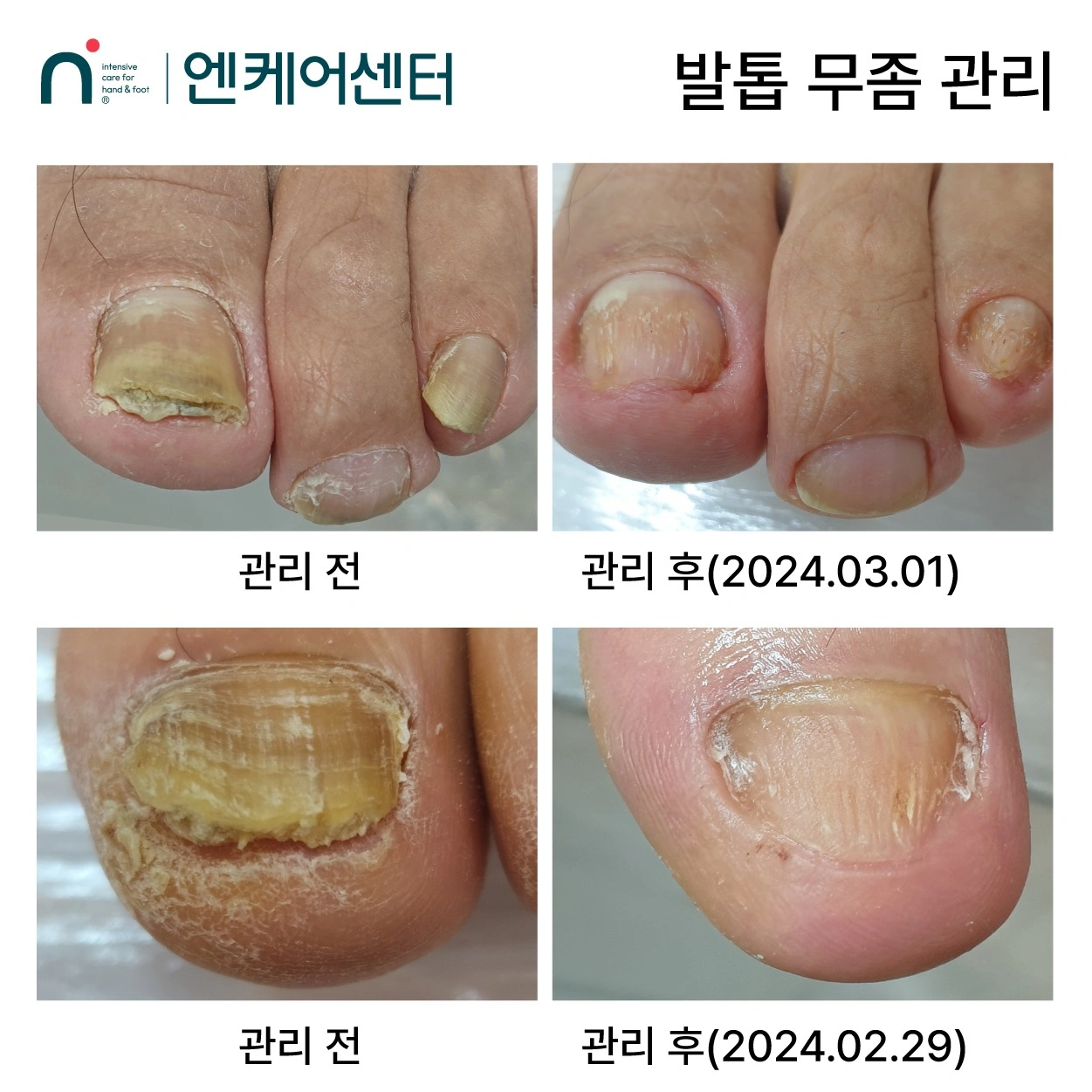 두꺼운 무좀 균집제거 모델 2명