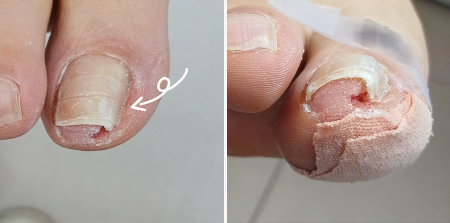 내성발톱 모델