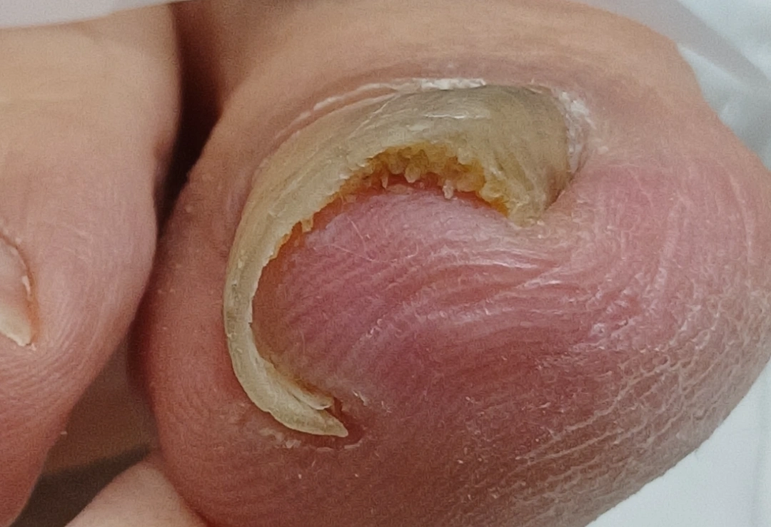 문제성발 모델(티눈.사마귀.심한내성,심한무좀발톱)