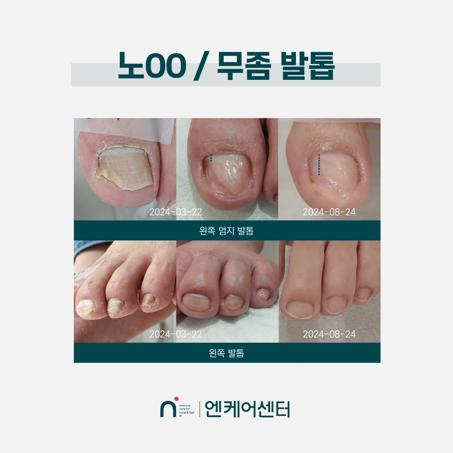 무좀발톱모델 (교육 무상관리)