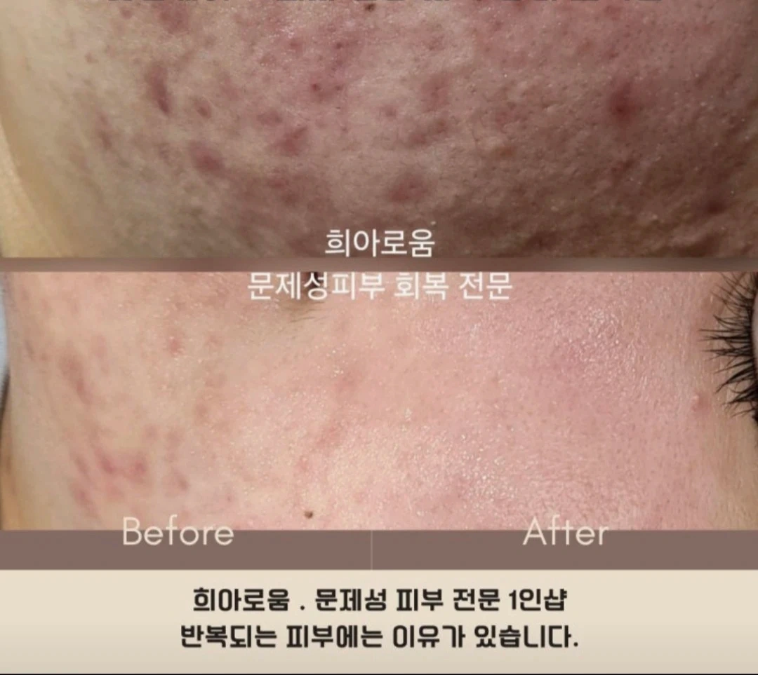 좁쌀여드름만 가능 압출 모델 구합니다.