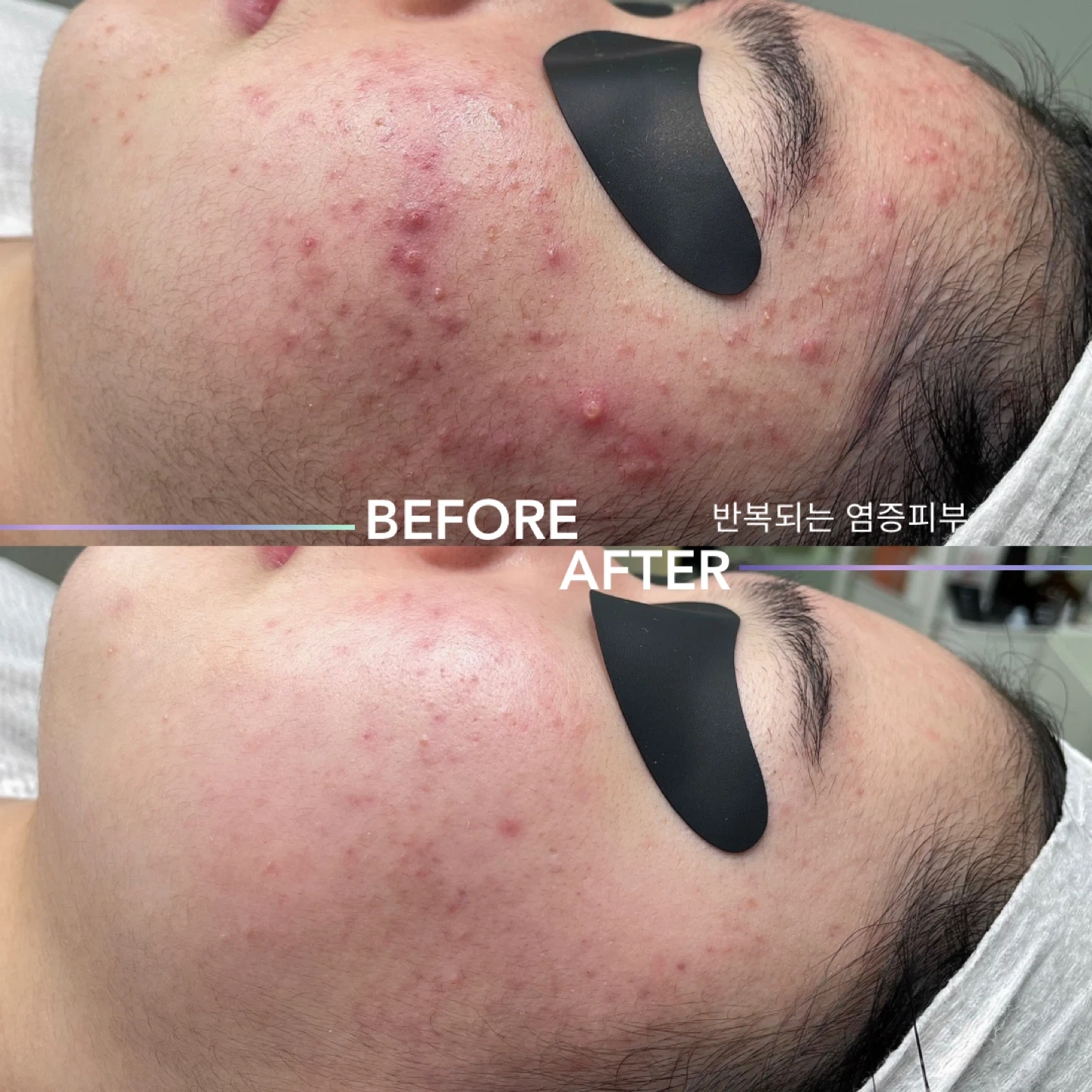 여드름압출 모델