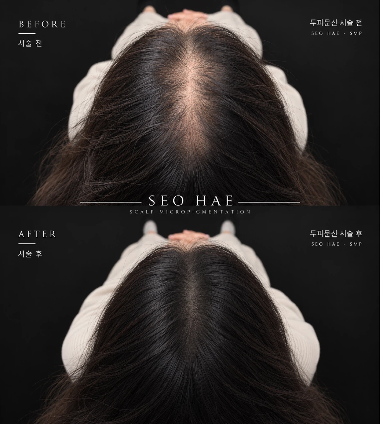 두피커버업 이미지 변신 구인