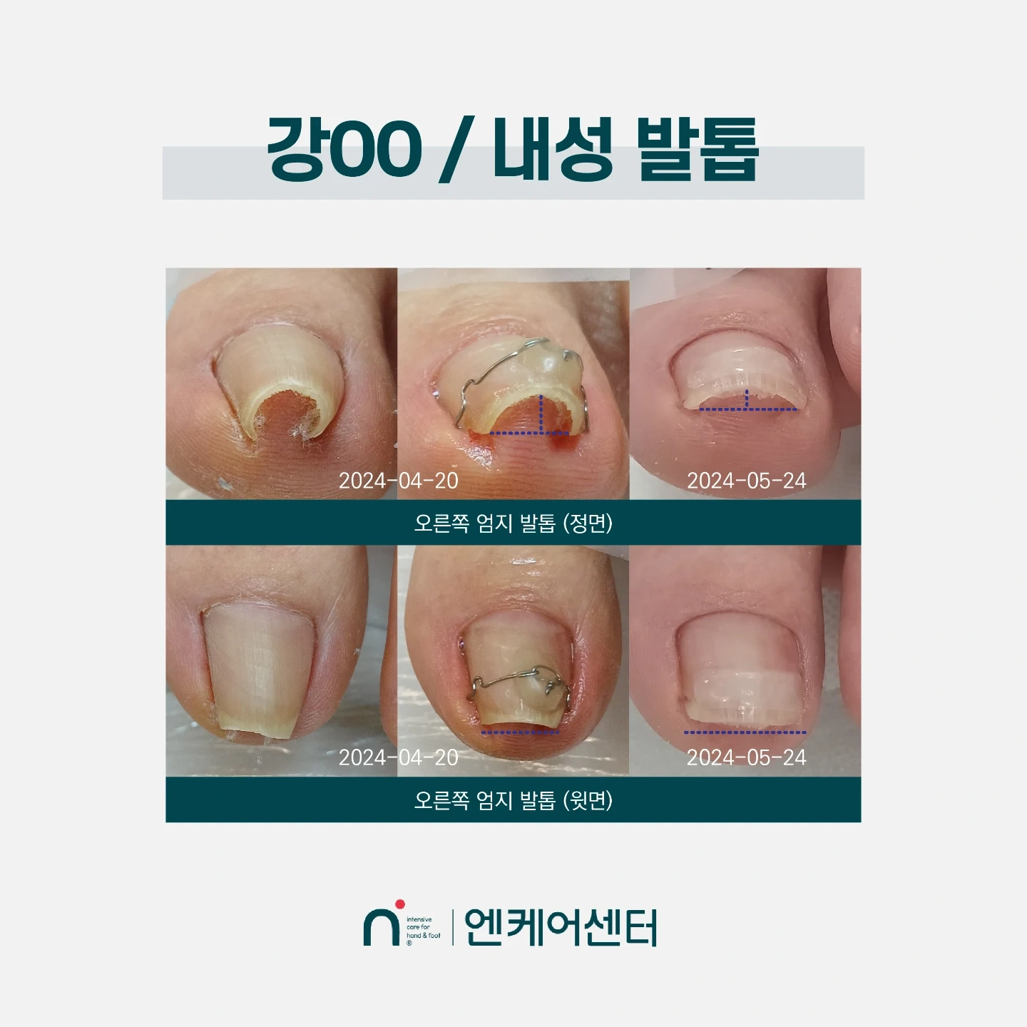 내성발톱,티눈 교육 모델 알바구함