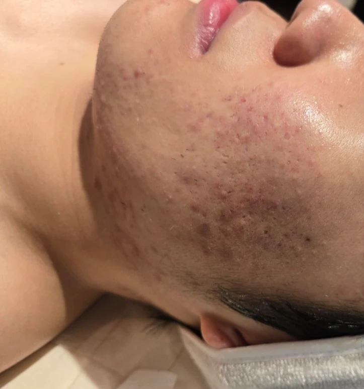 30일/(압출 받으실 분 ) 여드름 피부 모델 구함
