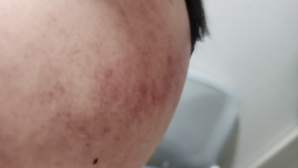 마사지 쑥뜸 picture 1