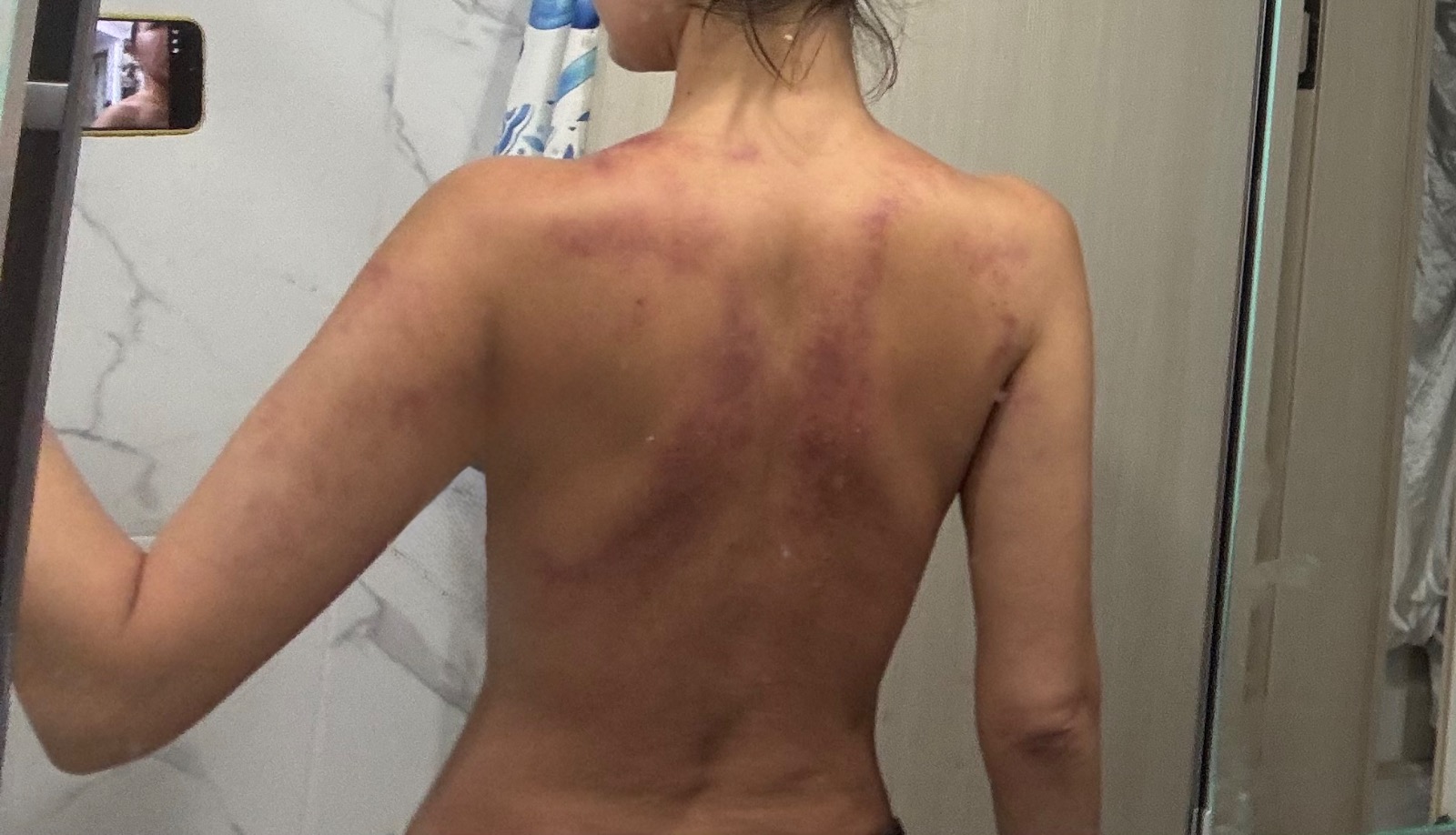 통증 관리 후기